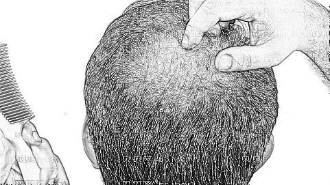 兰州植发哪家医院好？多少钱？附兰州植发医生排名名单
