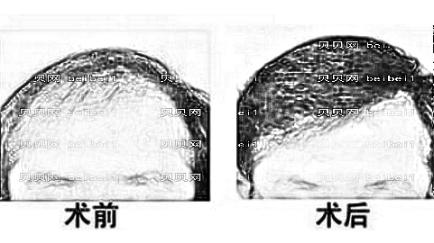 兰州植发哪家医院好？多少钱？附兰州植发医生排名名单