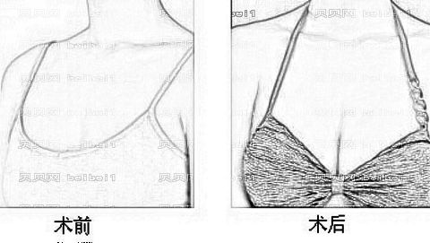福州丰胸哪个医生技术好?公布福州隆胸医生前五榜单，附