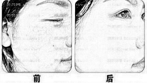 岳阳祛斑哪家医院好?岳阳激光祛斑多少钱?附祛斑介绍
