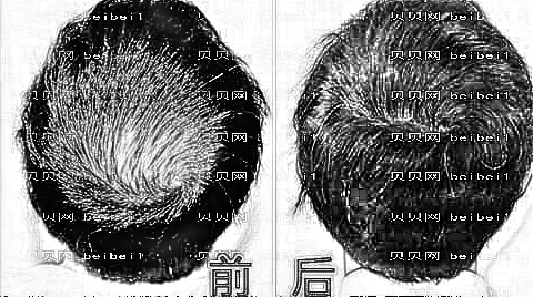 珠海植发哪家医院好？多少钱？附珠海植发医生排名名单
