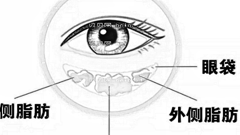 河北省二院割眼袋技术怎么样?割眼袋手术介绍及内部流出
