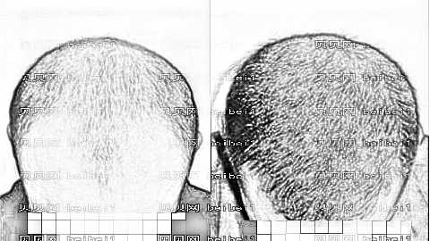 南宁植发哪家医院好?多少钱?附南宁植发医生排名名单