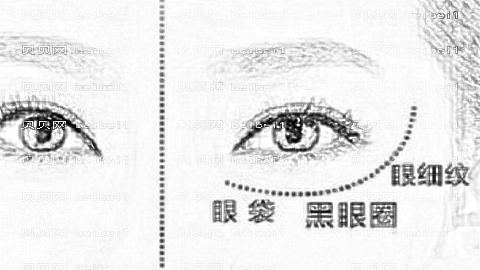 青岛伊美尔医院去眼袋怎么样?伊美尔眼袋抽脂介绍,医生较为好!