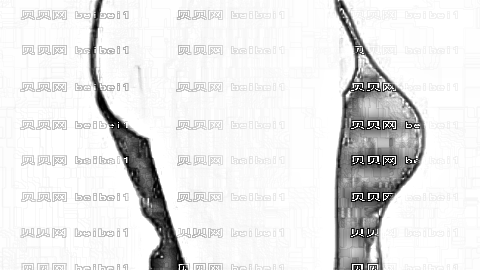 上海张怀军吸脂怎么样?上海张怀军吸脂介绍及