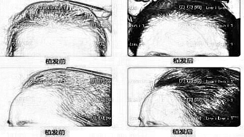 长春植发哪家医院好?多少钱?附长春植发医生排名名单