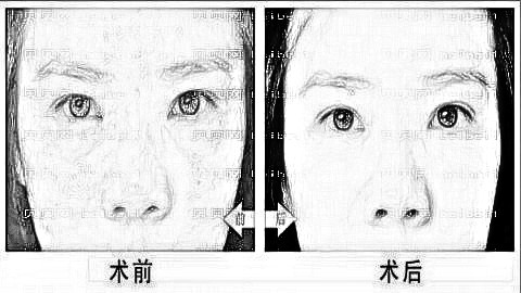 扬州去眼袋哪家医院好?扬州去眼袋医生排名名单&附介绍