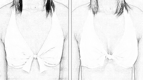 佛山丰胸哪个医生技术好?公布佛山隆胸医生前五榜单,附