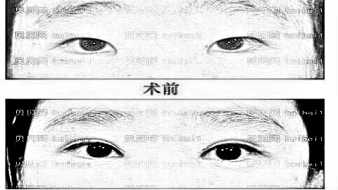 达州哪个医生做双眼皮厉害?达州陈军双眼皮做得怎么样?