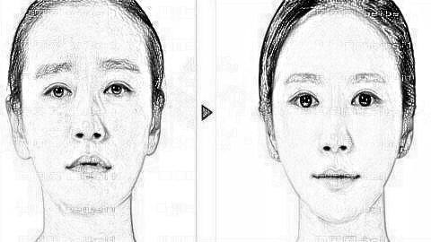 合肥下颌角整形哪家医院做得好?合肥做磨骨多少钱?附介绍