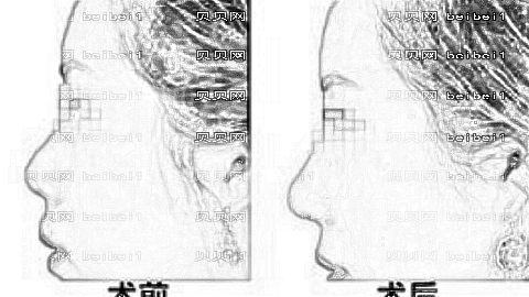 西安吴刚医生做鼻子自然吗?吴刚隆鼻口碑怎么样?附医生介绍