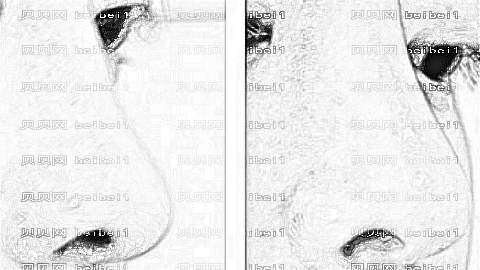 广州巫国辉医生鼻子做的自然吗?附巫国辉隆鼻+野生介绍