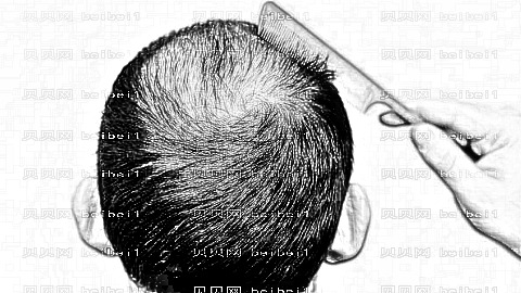 沈阳植发哪家医院好？多少钱？附沈阳植发医生排名名单