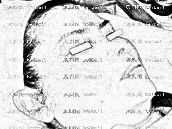 北京协和医院激光祛斑怎么样？怎么收费？附地址电话