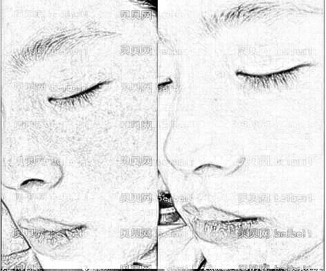 激光和激光美肤激光祛斑色素激光科普-黄褐斑、色素性黑眼圈