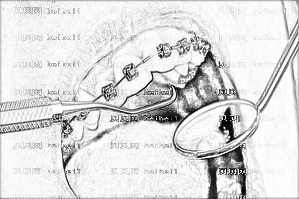 ,牙齿矫正_兰州大学一院牙齿矫正怎么样