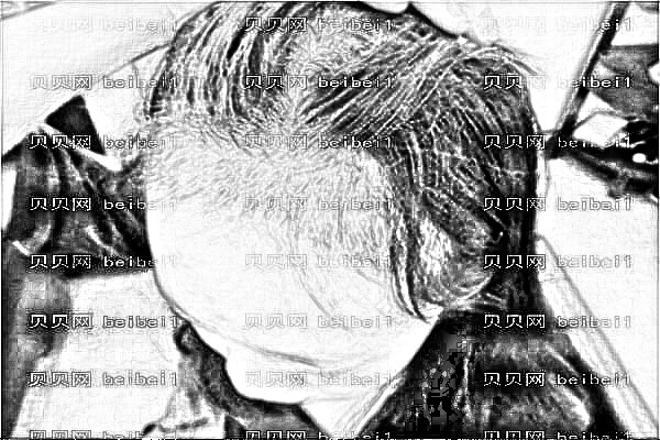 哈尔滨中医大一院植发哪位医生比较好_怎么样