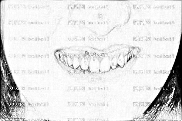 ,山西医科一院种牙较新发布