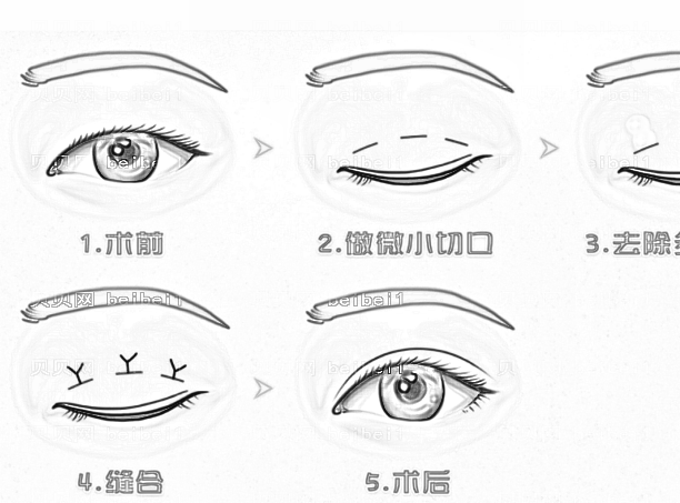 北京八大处宋维铭全切双眼皮+去脂肪可靠吗?多少钱?