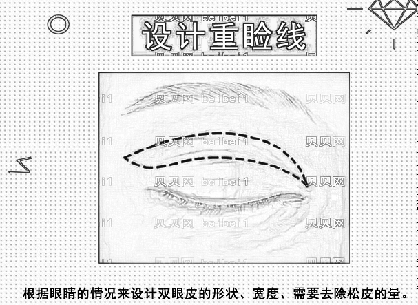 北京八大处宋维铭做的全切双眼皮+去脂肪怎么样? 请享受术前术后的图