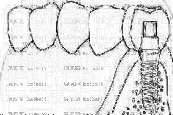 南通一院种植牙多少钱一颗【种植牙介绍】