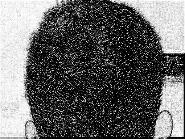 南方医科大学南方医院的苗勇脱发植发多少钱？价格优惠？
