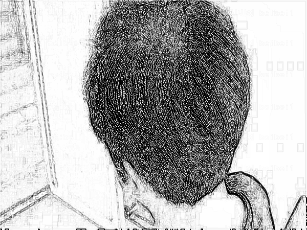 南方医科大学南方医院的苗勇脱发植发多少钱?怎么样?好吗?