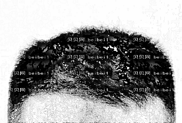 2022山西医科一院植发较新发布