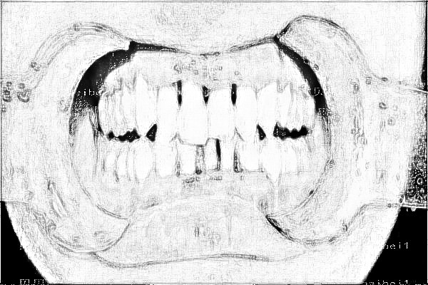 深圳北大医院种全瓷牙齿多少钱_全瓷牙齿能管多少年