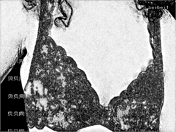 医学科学院整形外科刘春军自体脂肪注射隆乳介绍【价格】