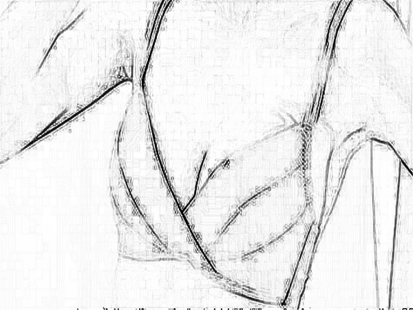 医学科学院整形外科刘春军自体脂肪注射隆乳果怎么样？贵不贵？