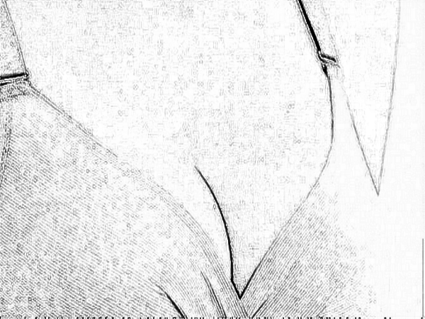 中国医学科学院整形外科刘春军自体脂肪注射隆乳怎么样?附自体脂肪注射隆乳介绍+医生信息!