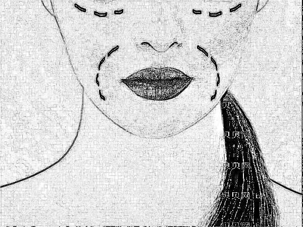 上海伯思立医疗美容热玛吉除皱好不好?多少钱?【较新优惠】