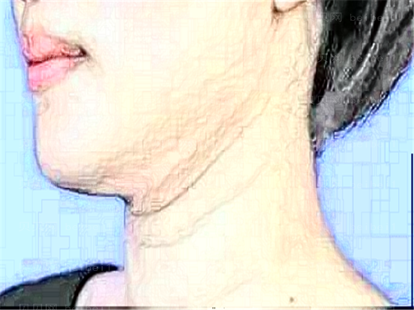 北京华韩整形医院热玛吉除皱多少钱?怎么样?果好吗?