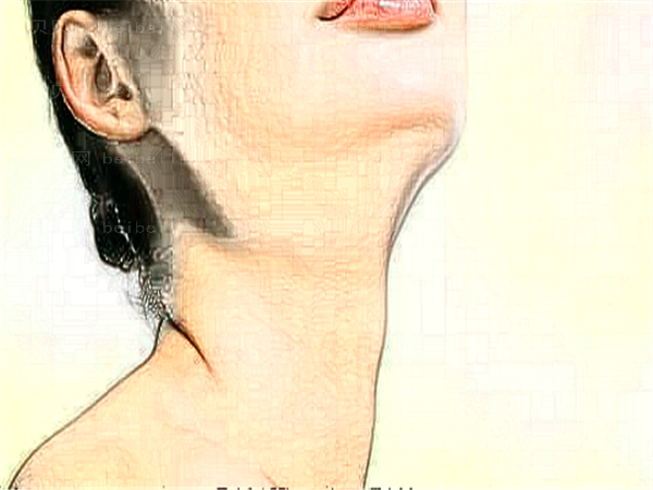 北京安加医疗部热玛吉除皱一般多少钱？有吗？