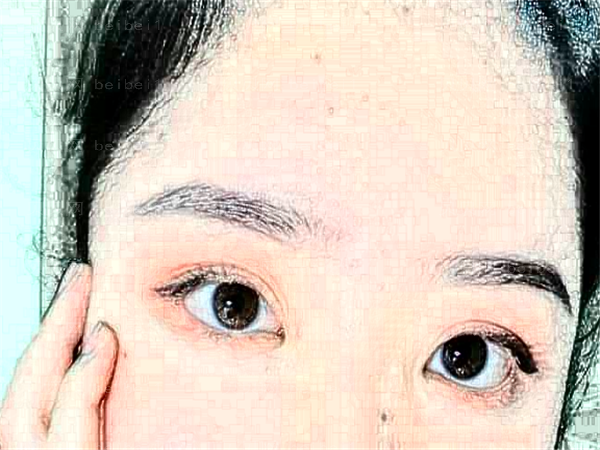 福州爱美尔眼睛割双眼皮项目价格分享|内附医生测评