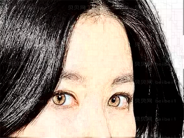 福州爱美尔眼睛割双眼皮多少钱?贵不贵?