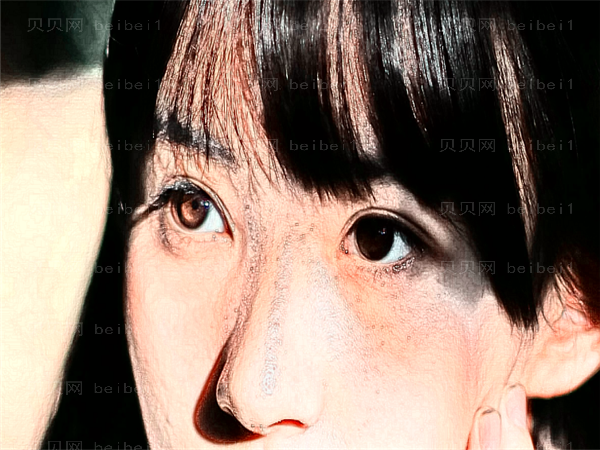 福州爱美尔眼睛割双眼皮技术怎么样？好吗？