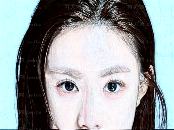 成都西婵整形医院眼睛割双眼皮技术怎么样？好吗？