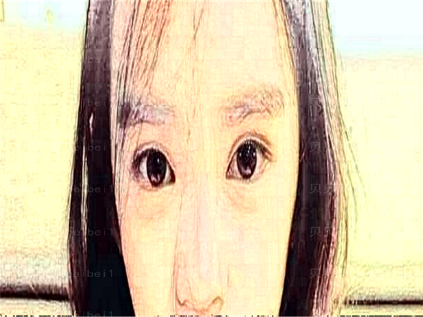 深圳非凡眼睛割双眼皮怎么样?价格公布丨真