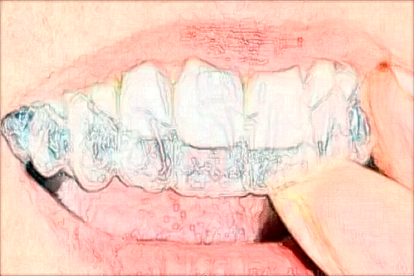 成都极光口腔牙齿不齐矫正费用多少?整形全过程