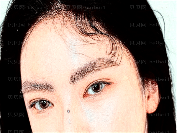 南阳三院眼睛割双眼皮怎么样？好不好？多少钱？