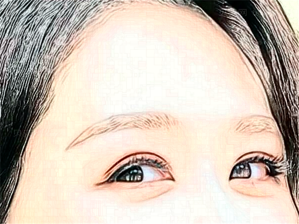 南阳三院眼睛割双眼皮多少钱?【费用、价格】