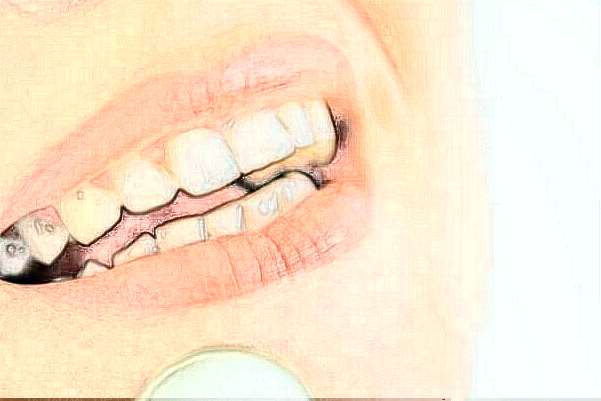 上海伊莱美牙齿种植哪个医生好?牙齿种植有危害吗