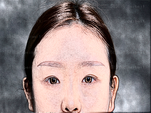 北京301整容医院眼睛割双眼皮多少钱?怎么样?好不好?