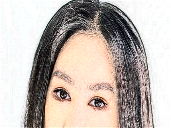 北京301整容医院眼睛割双眼皮多少钱?怎么样?好不好?