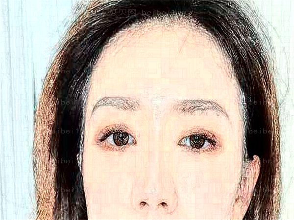 第四军医大学口腔医院全切割双眼皮价格大概多少钱哦,做的好不好啊