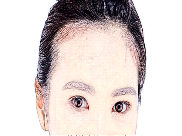 东莞市人民医院双眼皮失败修复哪个医生好？果好吗？
