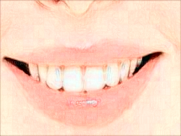 南京美奥口腔门诊部镶牙价格是多少?整牙过程分享
