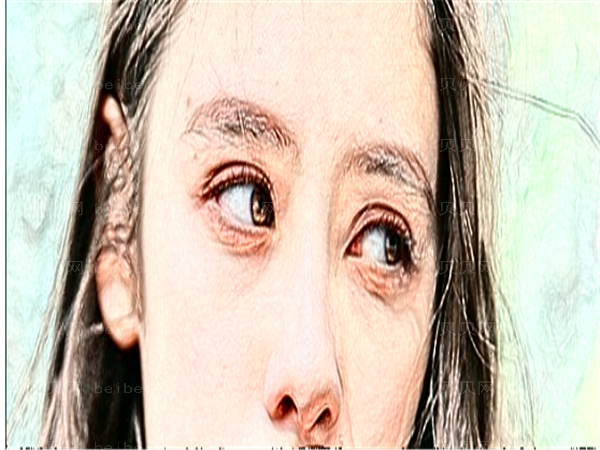 沈阳伊美尔开眼角贵不贵?案列+价格
